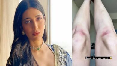 Shruti Haasan Got Injured