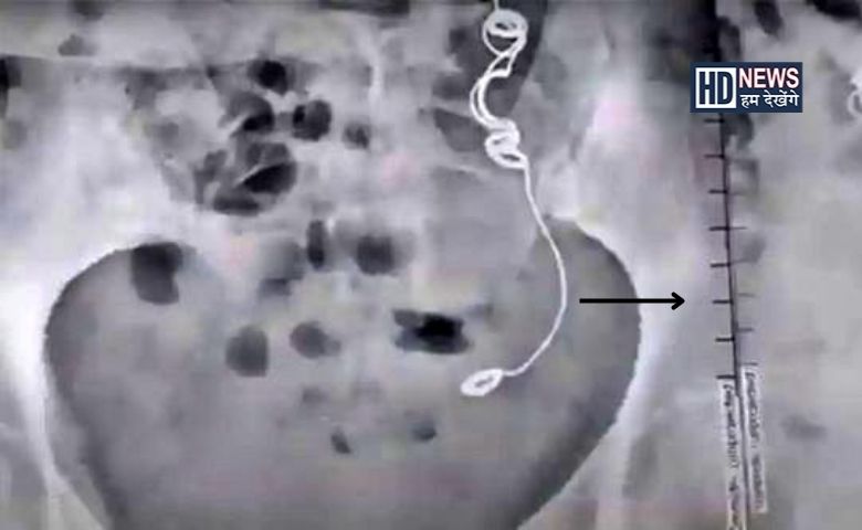 stomoch pain - Humdekhengenews