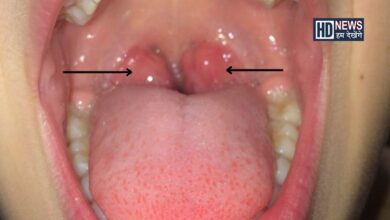 tonsilitis - Humdekhengenews