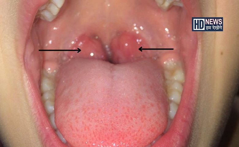 tonsilitis - Humdekhengenews